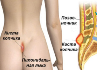 რა არის პილონიდალური დაავადება და მისი მკურნალობის მეთოდები!!