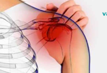 ბუნებრივი მკურნალობა “შებოჭილი” მხრისთვის და როგორ განვკურნოთ ის სწრაფად ..?!