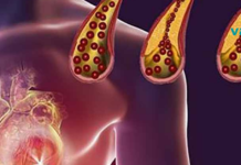 საკვები, რომელიც უნდა მიირთვათ ყოველდღიურად არტერიების სისუფთავის შესანარჩუნებლად!!