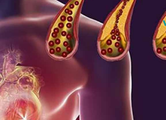 საკვები, რომელიც უნდა მიირთვათ ყოველდღიურად არტერიების სისუფთავის შესანარჩუნებლად!!