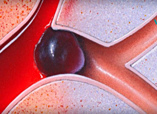 როგორ გავათხელოთ სხეულში სისხლი?! უდაოდ საჭირო ინფორმაციაა