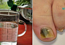 მოიცილეთ ფეხებიდან სოკო ამ ბუნებრივი სამ ინგრედიენტიანი რეცეპტით..