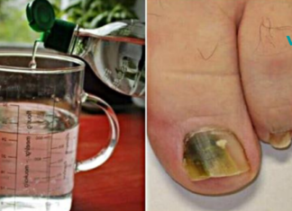 მოიცილეთ ფეხებიდან სოკო ამ ბუნებრივი სამ ინგრედიენტიანი რეცეპტით..