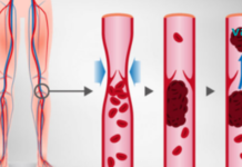 7 ნიშანი იმისა, რომ თქვენი არტერიები დაბლოკილია და საჭიროა დროულად უმკურნალოთ მას..