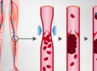 7 ნიშანი იმისა, რომ თქვენი არტერიები დაბლოკილია და  საჭიროა დროულად უმკურნალოთ მას..