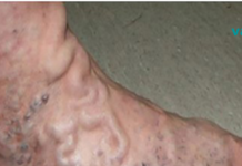 ქოქოსის ზეთი დაგეხმარებათ 10 წლით ახალგაზრდულად გამოიყურებოდეთ. გამოიყენეთ ეს საშუალება 2 კვირის განმავლობაში!