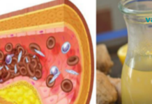 მე ყოველთვის მქონდა მაღალი ქოლესტერინი და მაღალი არტერიული წნევაც, მანამ სანამ ბებიაჩემმა არ მომიტანა ეს საშუალება და უარი ვთქვი ყველანაირ აბებზე!