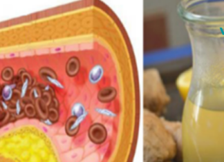 მე ყოველთვის მქონდა მაღალი ქოლესტერინი და მაღალი არტერიული წნევაც, მანამ სანამ ბებიაჩემმა არ მომიტანა ეს საშუალება და უარი ვთქვი ყველანაირ აბებზე!