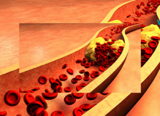 მიიღეთ ამ სასმელის 4 სუფრის კოვზი ყოველ დილით და დაემშვიდობეთ დაბლოკილ არტერიებს, არტერიულ მაღალ წნევას და ცუდ ქოლესტერინს!