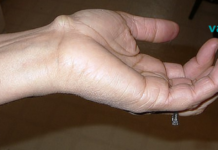 რამდენად ადვილია მსგავსი სახის გამონაზარდების მოცილება ხელებზე და ფეხებზე..!!