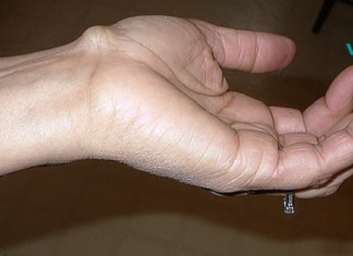 რამდენად ადვილია მსგავსი სახის გამონაზარდების მოცილება ხელებზე და ფეხებზე..!!