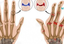 გაიგეთ რევმატოიდული ართრიტისა და ანთების ამ 3000 წლიანი მკურნალობის შესახებ