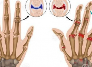 გაიგეთ რევმატოიდული ართრიტისა და ანთების ამ 3000 წლიანი მკურნალობის შესახებ