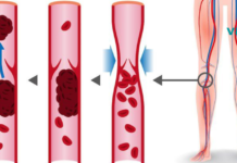 7 საკვები, რომელიც ათხელებს სისხლს და შეუძლია თრომბოზის თავიდან აცილება!!