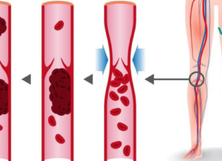 7 საკვები, რომელიც ათხელებს სისხლს და შეუძლია თრომბოზის თავიდან აცილება!!