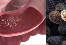 პარაზიტების 10 სიმპტომი და 7 პროდუქტი მათ მოსაშორებლად!