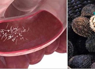 პარაზიტების 10 სიმპტომი და 7 პროდუქტი მათ მოსაშორებლად!