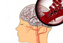 ინსულტის გამაფრთხილებელი ნიშნები, რომლებიც უნდა იცოდეთ!