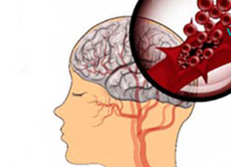 ინსულტის გამაფრთხილებელი ნიშნები, რომლებიც უნდა იცოდეთ!