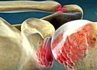 ართრიტის 10 სიმპტომი: როგორ ავიცილოთ თავიდან სახსრების ტკივილი?