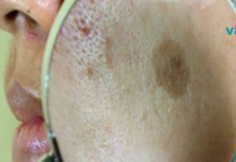 ნატურალური მკურნალობა სახის ლაქების მოსაშორებლად!