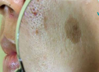 ნატურალური მკურნალობა სახის ლაქების მოსაშორებლად!