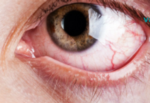 ეს მეთოდი აუმჯობესებს დაბინდულ მხედველობას და ხსნის თვალის წვას მარტივი სახლის რეცეპტით!