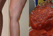 აღარასოდეს დაუჯერებთ თქვენს ექიმს, რადგან ისინი მალავენ, რომ ეს წამალი ხსნის ვარიკოზულ ვენებს სულ რაღაც 20 დღეში!