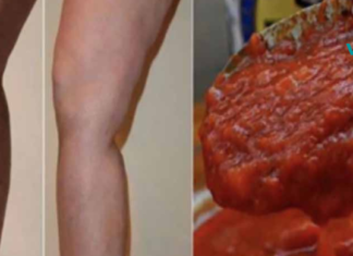 აღარასოდეს დაუჯერებთ თქვენს ექიმს, რადგან ისინი მალავენ, რომ ეს წამალი ხსნის ვარიკოზულ ვენებს სულ რაღაც 20 დღეში!