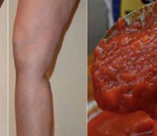 აღარასოდეს დაუჯერებთ თქვენს ექიმს, რადგან ისინი მალავენ, რომ ეს წამალი ხსნის ვარიკოზულ ვენებს სულ რაღაც 20 დღეში!