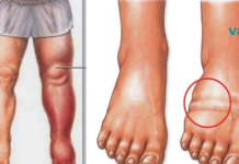 რა იწვევს წყლის შეკავებას, შებერილობას და როგორ ავიცილოთ თავიდან ეს ყოველივე ?!