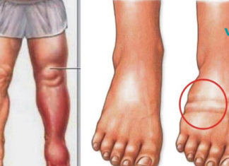 რა იწვევს წყლის შეკავებას, შებერილობას და როგორ ავიცილოთ თავიდან ეს ყოველივე ?!