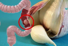 მსხვილი ნაწლავის დაავადებების 50%-ის პრევენცია შესაძლებელია ამ 9 საშუალების დახმარებით!