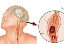 თავის ტვინის ქირურგი განმარტავს ანევრიზმის გამაფრთხილებელ ნიშნებს, რომლებიც არასოდეს არ უნდა უგულებელყოთ.. ფრთხილად იყავით!