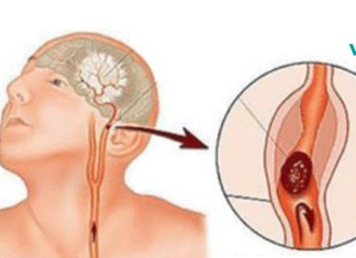 თავის ტვინის ქირურგი განმარტავს ანევრიზმის გამაფრთხილებელ ნიშნებს, რომლებიც არასოდეს არ უნდა უგულებელყოთ.. ფრთხილად იყავით!