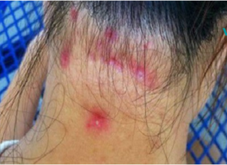 ფიბრომიალგიის სიმპტომები: ნებისმიერს, ვისაც აქვს კუნთების ტკივილი, უნდა წაიკითხოს ეს