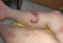 ცუდი სისხლის მიმოქცევა გაქვთ? ნახეთ, როგორ შეგიძლიათ გადაჭრათ ეს პრობლემა!