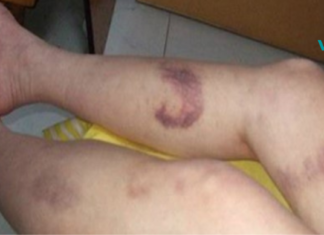 ცუდი სისხლის მიმოქცევა გაქვთ? ნახეთ, როგორ შეგიძლიათ გადაჭრათ ეს პრობლემა!