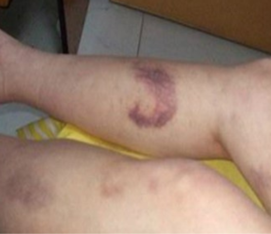 ცუდი სისხლის მიმოქცევა გაქვთ? ნახეთ, როგორ შეგიძლიათ გადაჭრათ ეს პრობლემა!