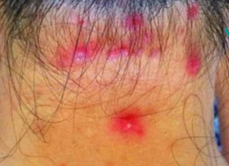 ფიბრომიალგიის სიმპტომები – ნებისმიერმა ადამიანმა, რომელსაც აქვს კუნთების ტკივილი, უნდა წაიკითხოს ეს!