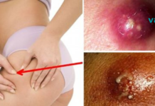 6 ეფექტური საშინაო საშუალება ბარძაყის შიგნით და დუნდულოებზე ფურუნკულების მოსაშორებლად!