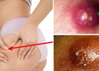 6 ეფექტური საშინაო საშუალება ბარძაყის შიგნით და დუნდულოებზე ფურუნკულების მოსაშორებლად!