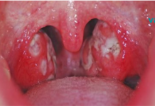 გთხოვთ, წაიკითხოთ ეს ინფორმაცია სანამ წაიშლება! ყელის ინფექციის მკურნალობა თქვენს ხელშია