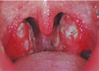 გთხოვთ, წაიკითხოთ ეს ინფორმაცია სანამ წაიშლება! ყელის ინფექციის მკურნალობა თქვენს ხელშია