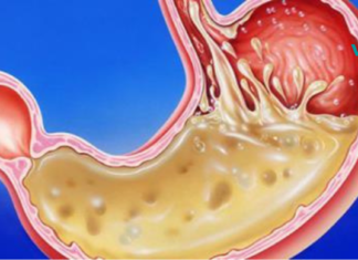 3 ეფექტური ბუნებრივი საშუალება კუჭის მჟავა რეფლექსისთვის..!!