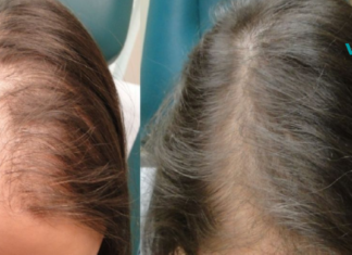 ეს ყველაზე ეფექტური ნიღაბია თმის ცვენის წინააღმდეგ. უბრალოდ უნდა სცადოთ!