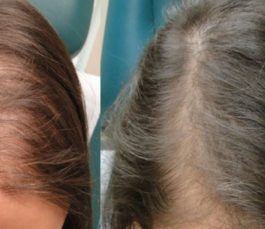 ეს ყველაზე ეფექტური ნიღაბია თმის ცვენის წინააღმდეგ. უბრალოდ უნდა სცადოთ!