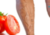 როგორ ვუმკურნალოთ ვენების ვარიკოზულ დაავადებას პომიდვრის დახმარებით? მარტივი და ეფექტური მეთოდია