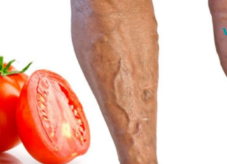 როგორ ვუმკურნალოთ ვენების ვარიკოზულ დაავადებას პომიდვრის დახმარებით? მარტივი და ეფექტური მეთოდია