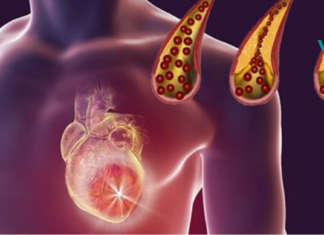 10 საკვები, რომელიც ყოველდღიურად უნდა მიირთვათ არტერიების გასაწმენდად!